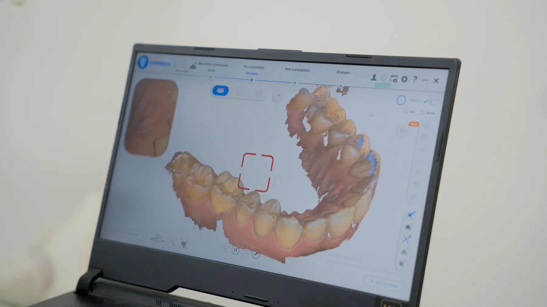 Orthodontie esthétique